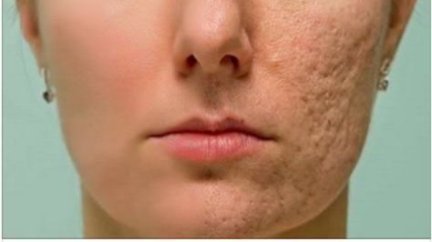 Estas recetas caseras esta causando furor en Internet¡ elimina las manchas oscuras de tus axilas,codos y cuello en tan solo 15 minutos.