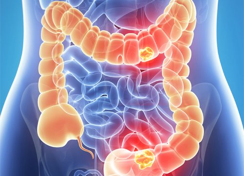 ¡ATENCION! 5 Síntomas del cáncer de colon!!