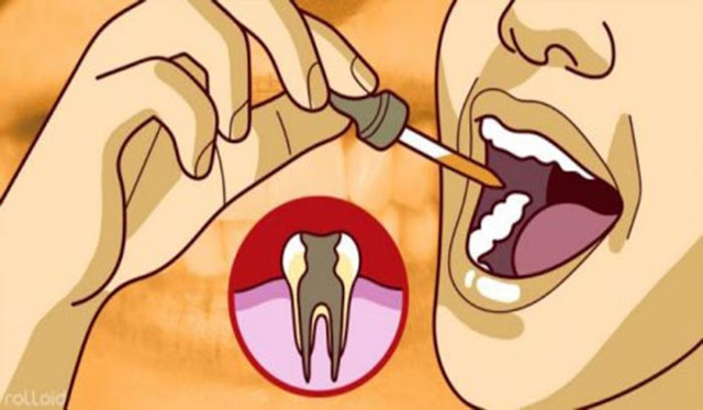 Los dentistas lo tenian bien guardado, elimina las caries y el dolor de muelas con este remedio casero