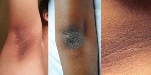 Mira a como quitar esas manchas oscuras de tu cuello, axilas y codos en 15 minutos