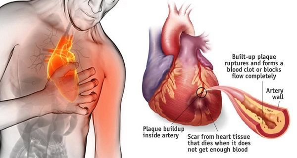 80% de ataques al corazón podrían evitarse si todos hicieran estas 5 cosas fáciles