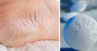 TRUCO PARA ELIMINA LA DUREZA DE LOS PIES CON ASPIRINAS.