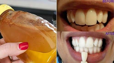Realiza gárgaras con este ingrediente y verás lo que pasa en tus dientes, es increíble…