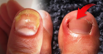 REMEDIO “EXTRAÑO” PERO MUY EFECTIVO PARA ELIMINAR UÑAS ENCARNADAS