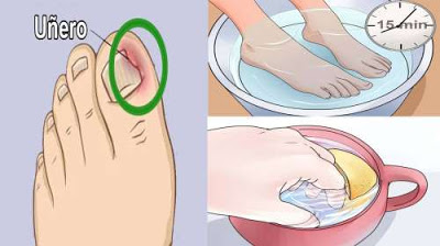Remedio casero muy efectivo para curar un uñero!!!