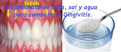 BICARBONATO DE SODA, SAL Y AGUA PARA COMBATIR LA GINGIVITIS.