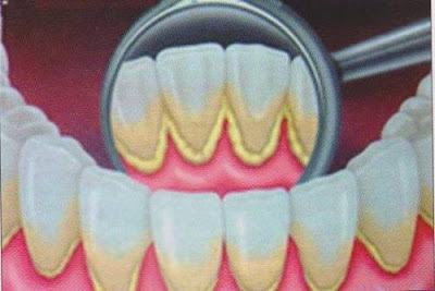 ELIMINA EL SARRO DE TUS DIENTES DEFINITIVAMENTE DE MANERA NATURAL.