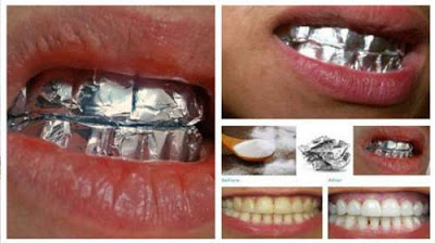Envuelve tus dientes con papel aluminio y no créeras los resultados..