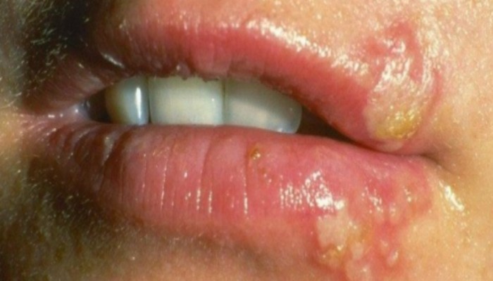 8 REMEDIOS CASERO CONTRA EL HERPES SIMPLE