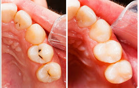 Increíble nueva pasta dental cura las caries sin perforar. Es sorprendente, compártelo.!