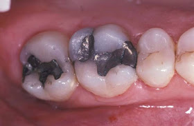 Existe un asesino en tu boca: elimina los empastes de amalgama y veras como mejora tu salud…