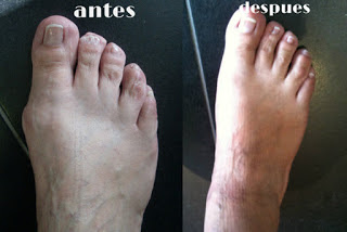 Este potente remedio eliminara sus juanetes en tan solo 10 dias
