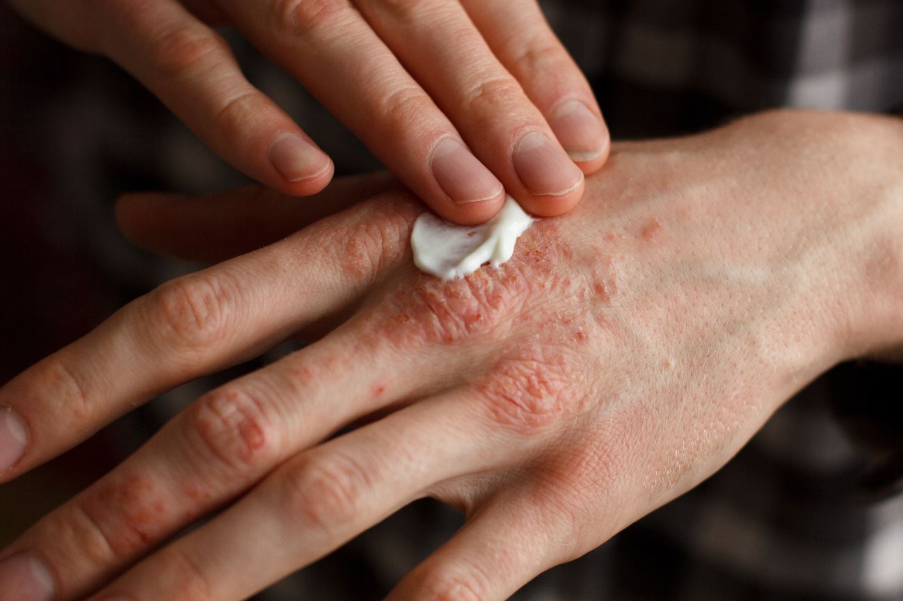 REMEDIO NATURAL CONTRA LA PSORIASIS Y MANCHAS EN LA PIEL