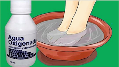Elimina los hongos de tus uñas y pies definitivamente con este remedio casero