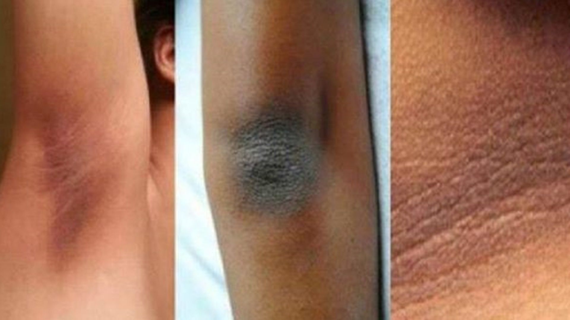 Adiós manchas negras en la piel! – dedos, codos, rodillas, etc.