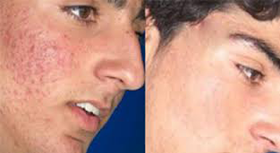 Microdermoabrasión casera ¡Elimina manchas, arrugas, cicatrices y acné! Tu solución.
