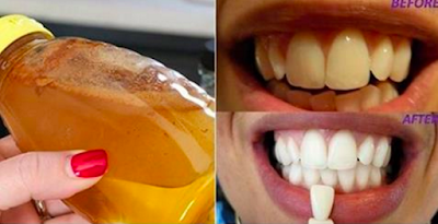 ¡La Mejor Receta Natural para Blanquear tus Dientes!