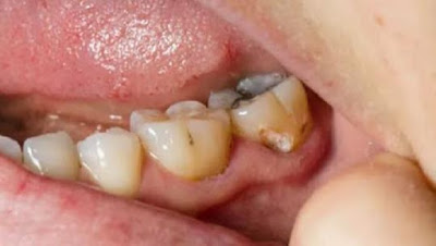No Importa Cuanta Caries Tengas Elimínala Desde Casa Fácilmente