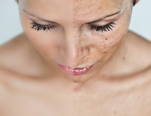 ¡STOP MANCHAS FACIALES! TRES RECETAS CASERAS PARA ELIMINARLAS
