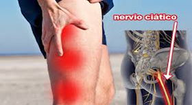 Como aliviar rápidamente dolor del nervio ciatico..!! Mira como hacerlo.