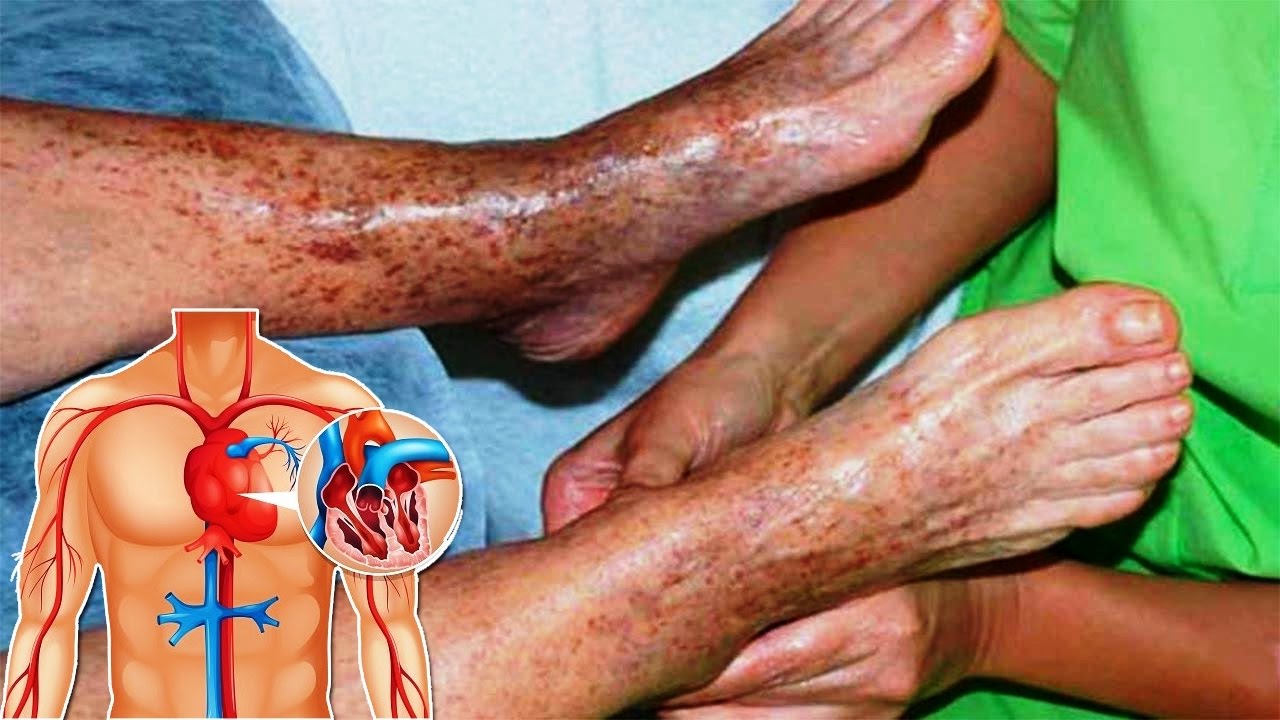 Remedio con Aloe Vera para curar las varices y reactivar la circulación de la sangre.
