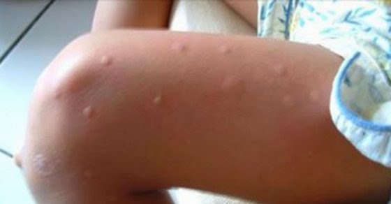 Es usted un imán de los mosquitos Aquí les explicamos por que y como podemos evitarlo..!!!