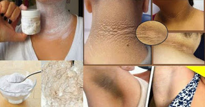 ASÍ ES COMO MI MADRE ELIMINA LAS MANCHAS DEL CUELLO, AXILAS Y CODOS DE FORMA NATURAL.