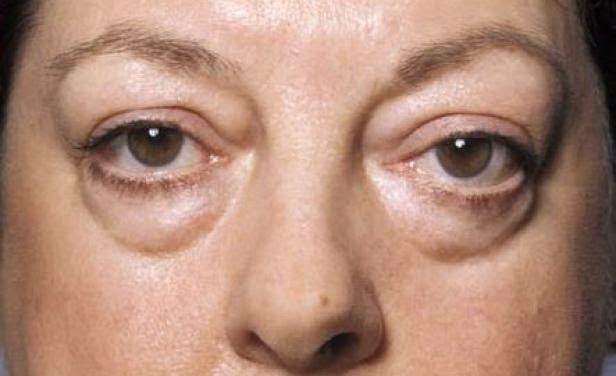 Como podemos deshacerce de las bolsas de los ojos con estos remedios naturales..!!! HOME » UNLABELLED