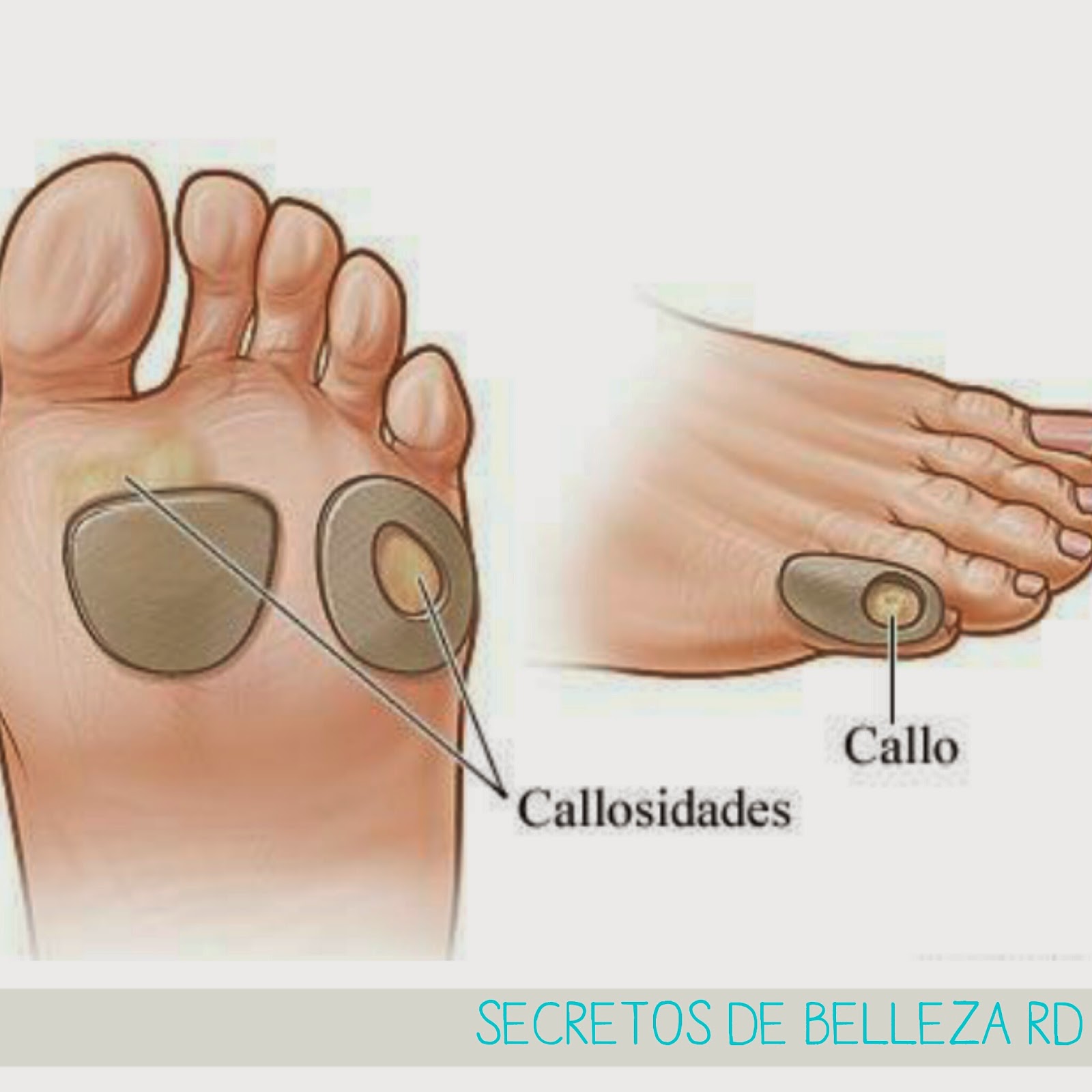 QUE SUCEDE EN LA PIEL PARA QUE SE PRODUZCA UN CALLO??