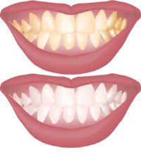 Remedios caseros para Dientes manchados o amarillos