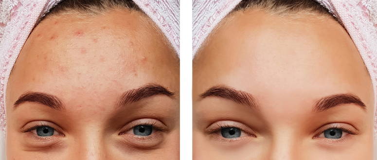 Cuidados naturales para el cutis (seco, normal, graso, acne)