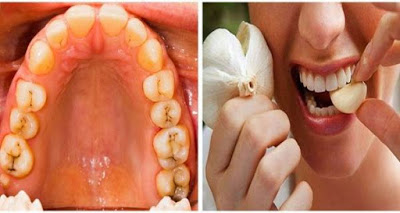 REMEDIOS CASEROS PARA SANAR Y REVERTIR LAS CARIES