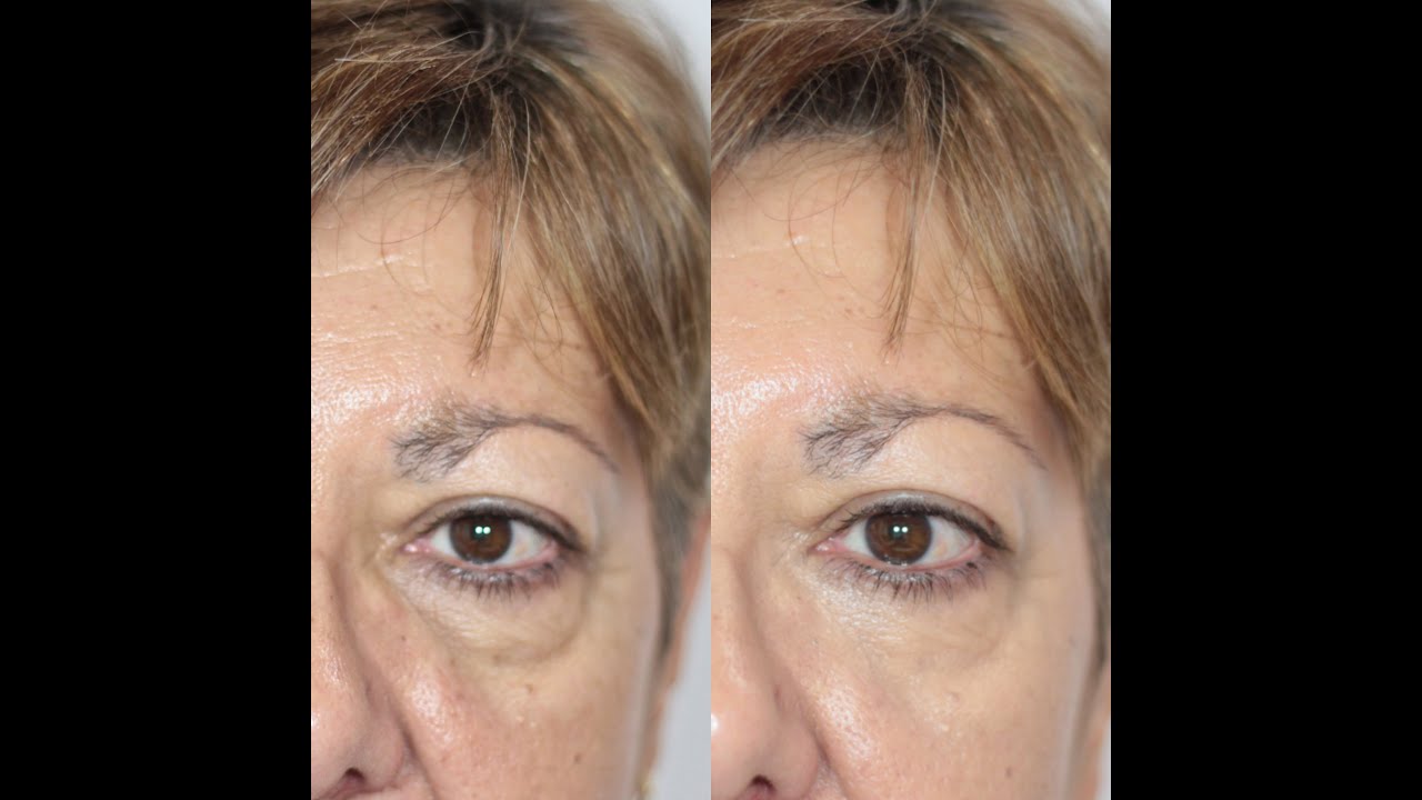 Eliminar bolsas y ojeras con leche